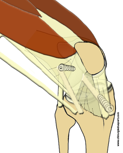 fascia lata prelevement Mac intosh passage de la greffe et vis .jpg